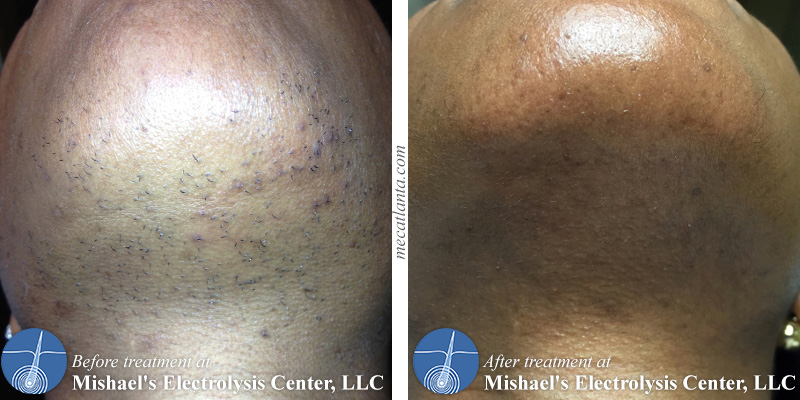 Permanently remove unwanted hair at Mishael's Electrolysis Center in Atlanta, GA
