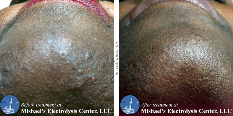 laser hair removal for african american skin msn