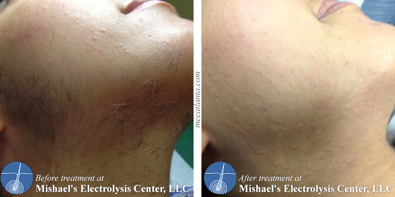 Feel stuck with unwanted hair? Mishael's can help!