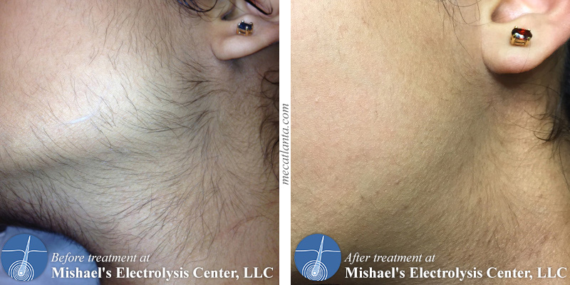 Electrolysis by Mishael's Electrolysis Center in Atlanta, GA give you hair-free confidence