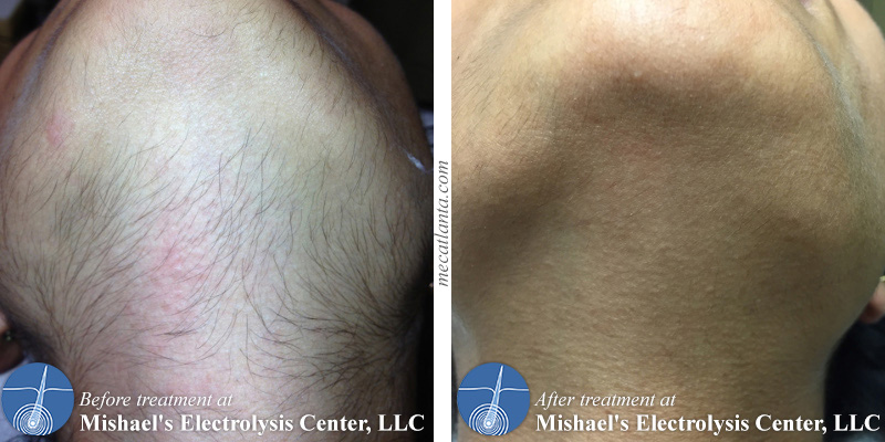 Electrolysis by Mishael's Electrolysis Center in Atlanta, GA give you hair-free confidence