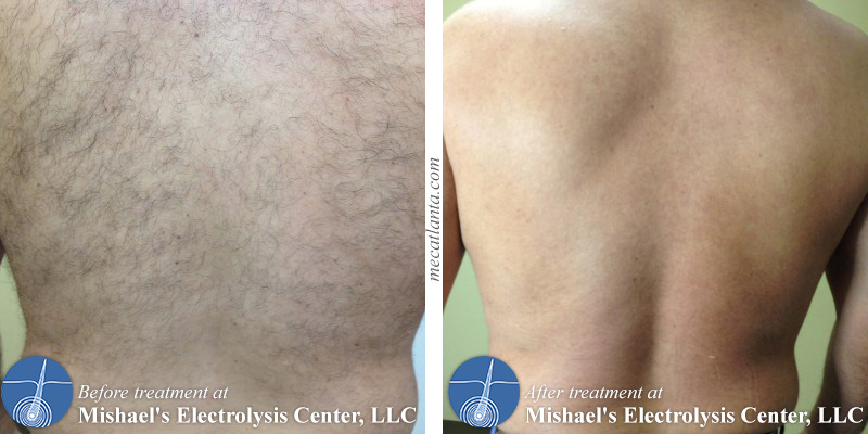 Unwanted back hair bothering you? Call Mishael's Electrolysis Center