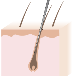 Electrolysis Hair Removal Works for All