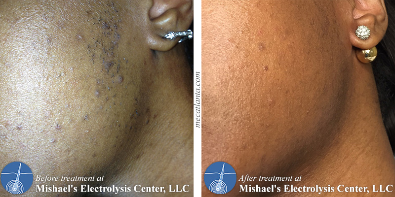 Before After Electrolysis Hair Removal Mishael s Electrolysis