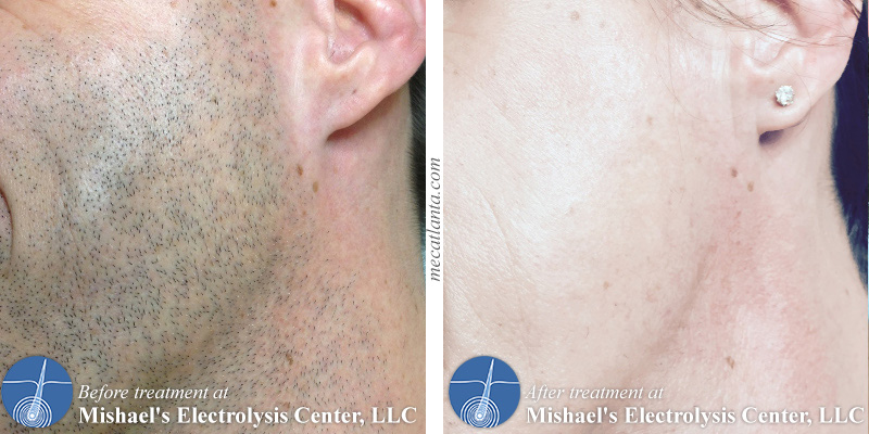 Before & After Electrolysis Hair Removal | Mishael's Electrolysis Center