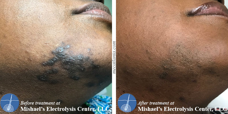 Before After Electrolysis Hair Removal Mishael s Electrolysis